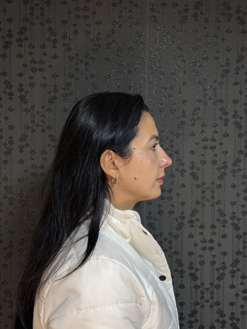 Antes da harmonização de contorno facial