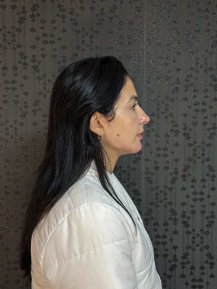 Depois da harmonização de contorno facial