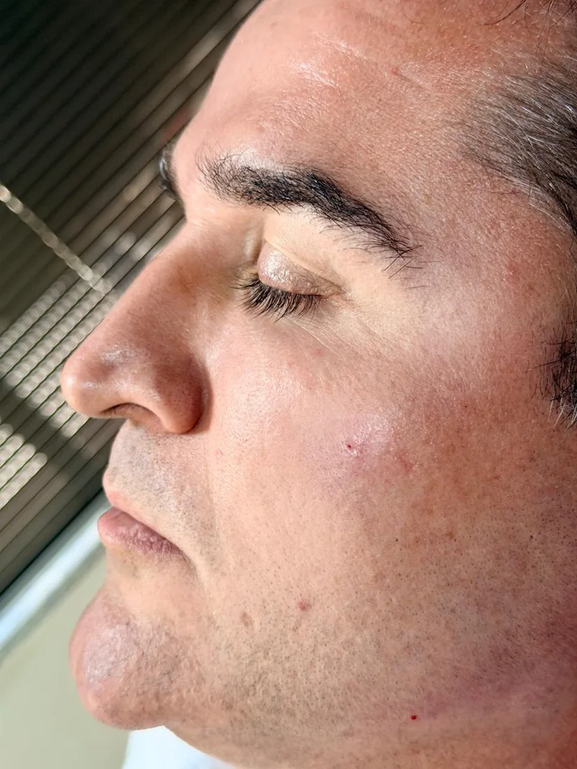 Antes da harmonização de contorno mandibular