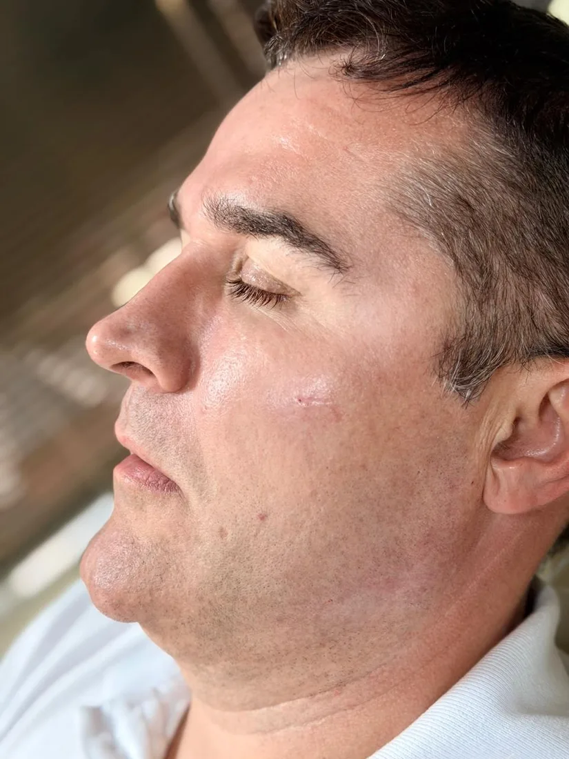 Depois da harmonização de contorno mandibular