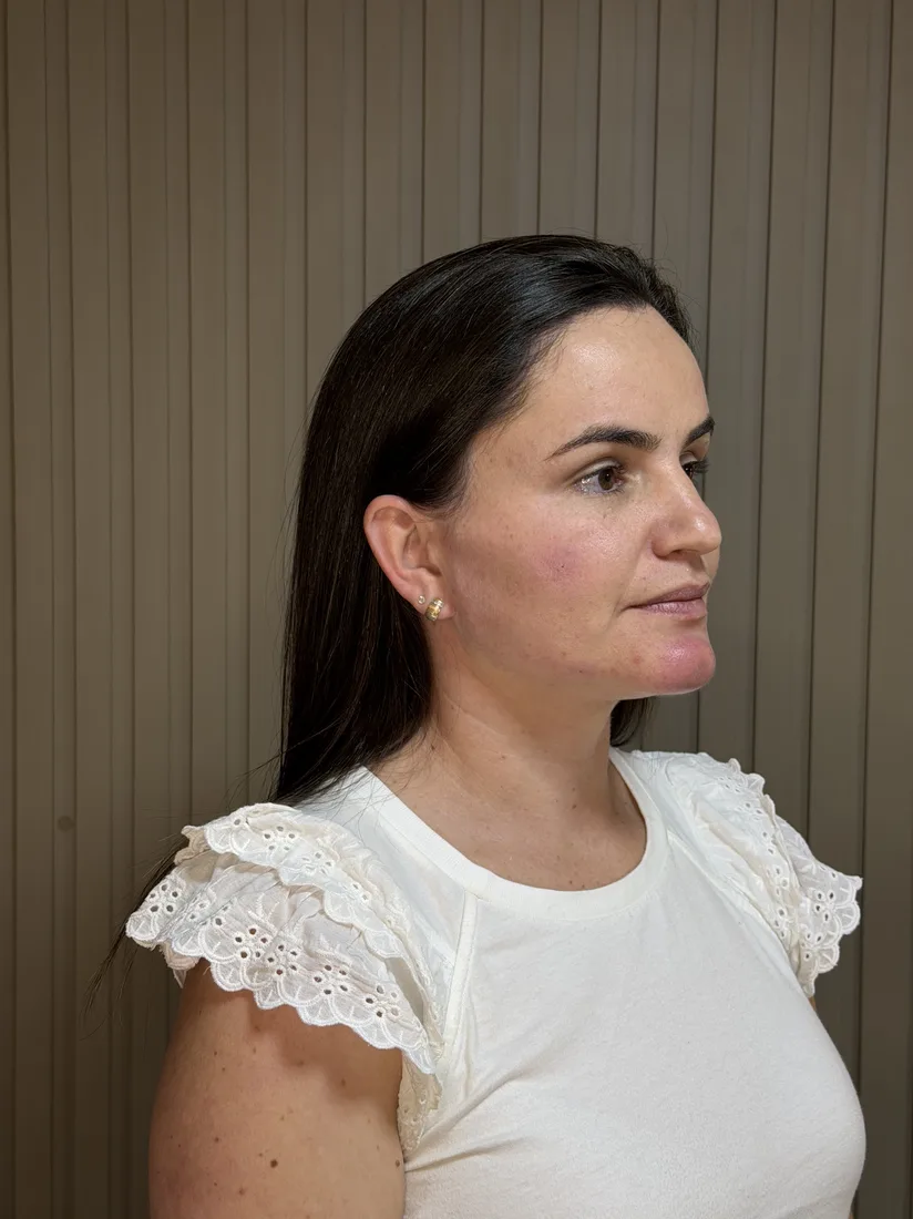 Depois do preenchimento facial