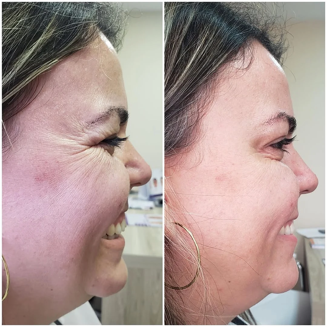 Botox sutil que realça a melhor versão