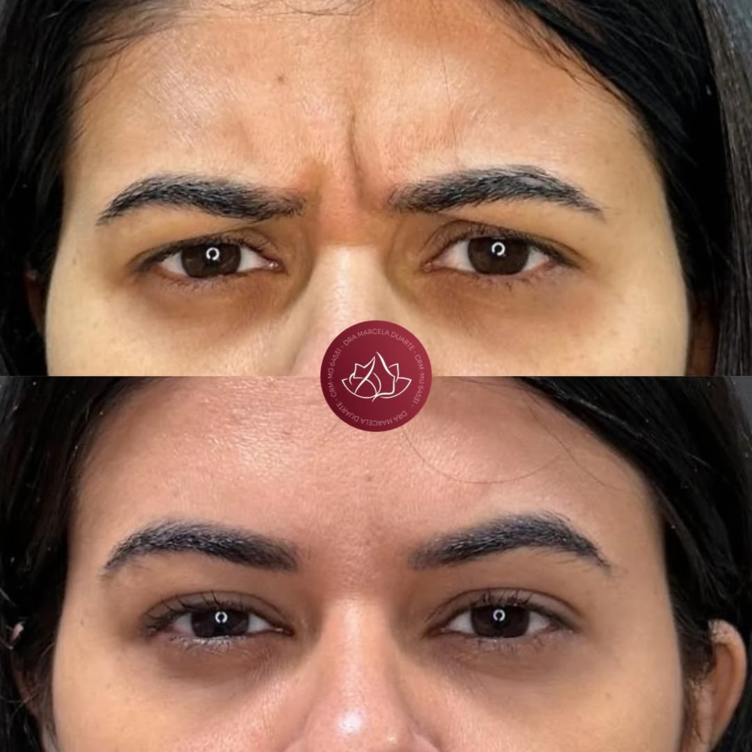 Antes e depois de aplicação de Botox