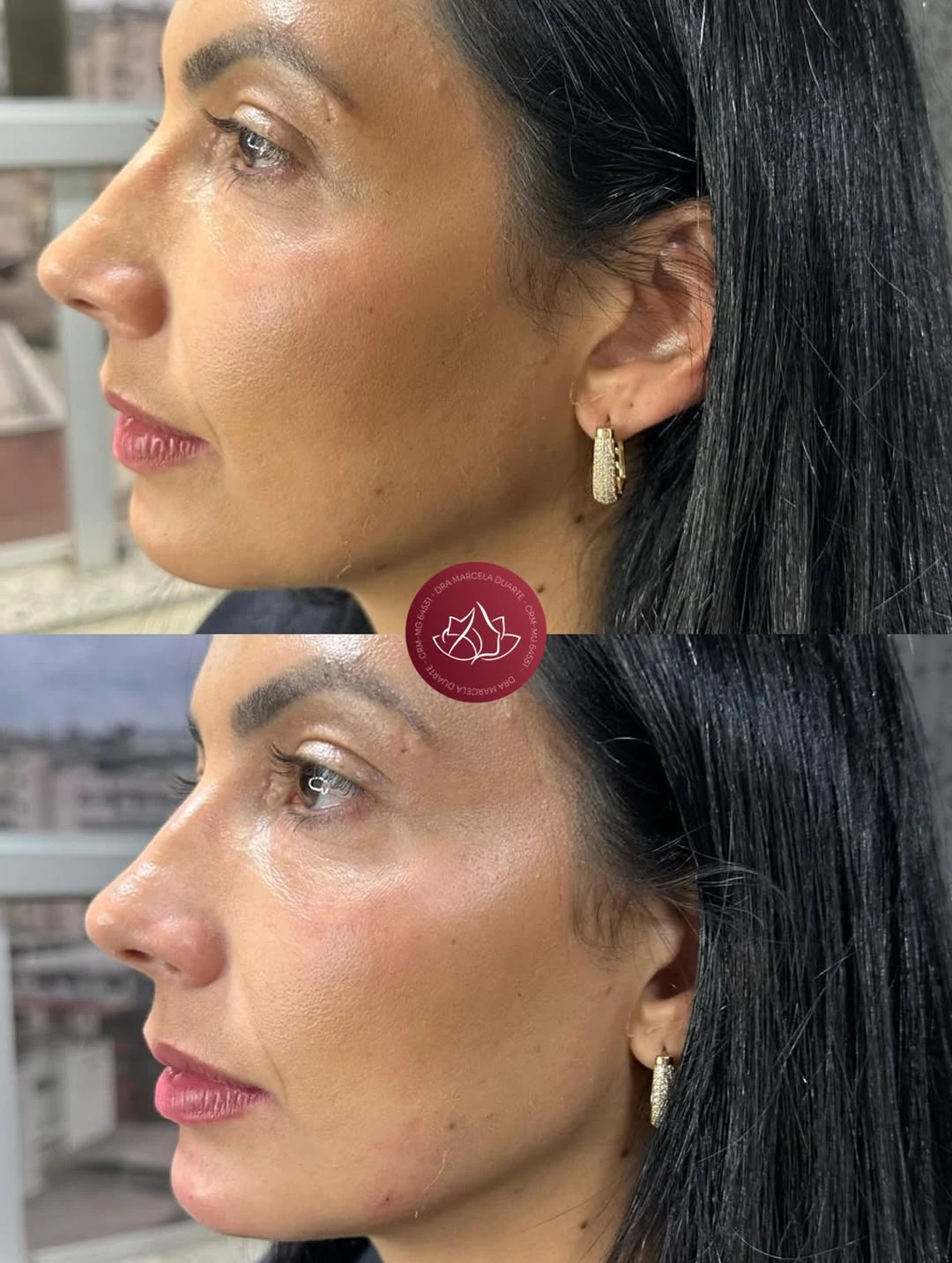 Harmonia facial com preenchimento de mento